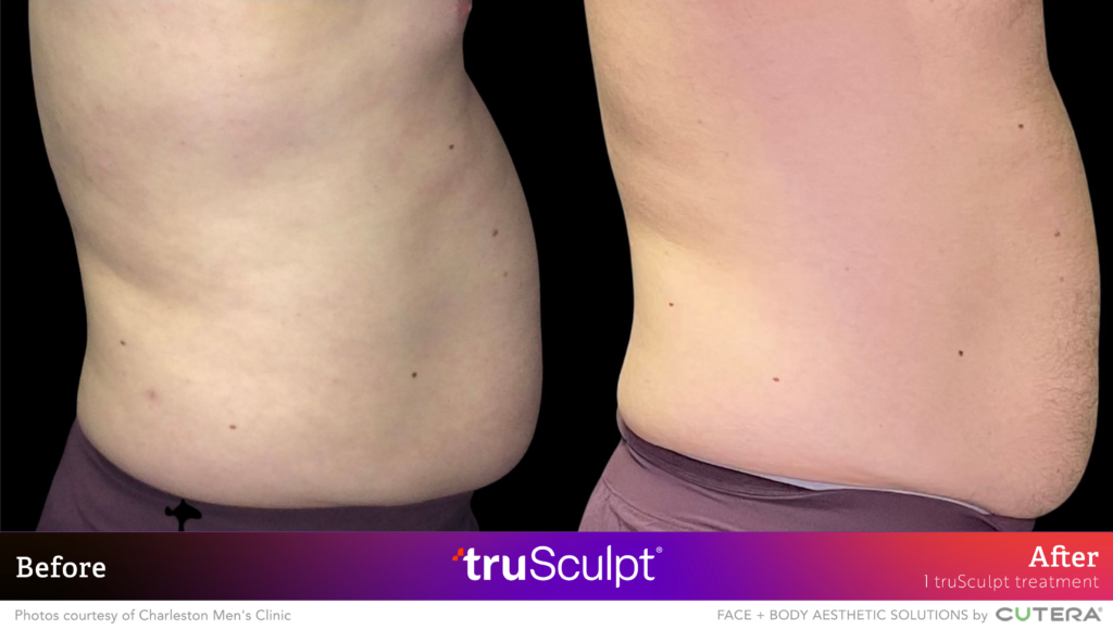 01_truSculpt ID_B&A_Charleston Trusculpt Results Before After