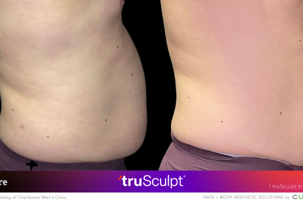 Trusculpt Results Before After