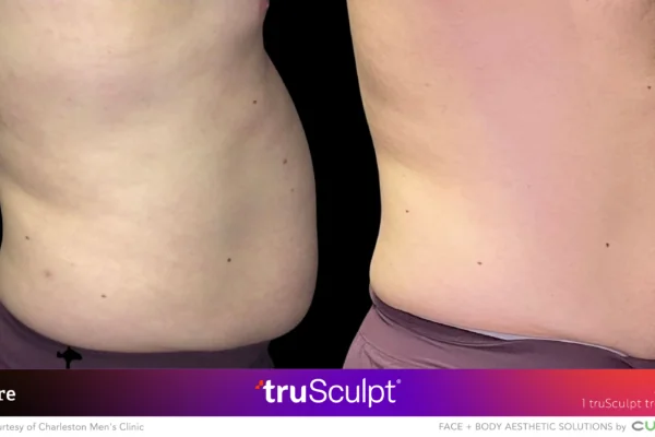 Trusculpt Results Before After
