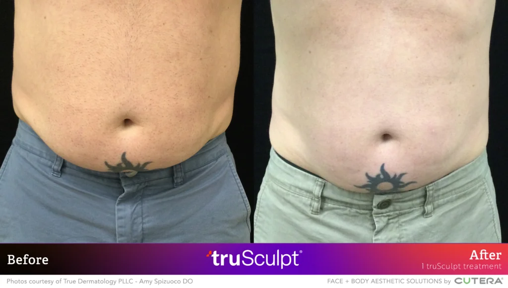 truSculpt Fat Reduction Results: Abdominal Transformation Before and after comparison of significant abdominal fat reduction with one truSculpt treatment