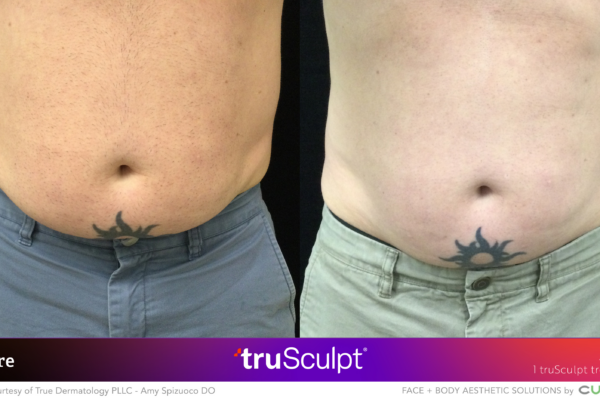 Before and after comparison of significant abdominal fat reduction with one truSculpt treatment