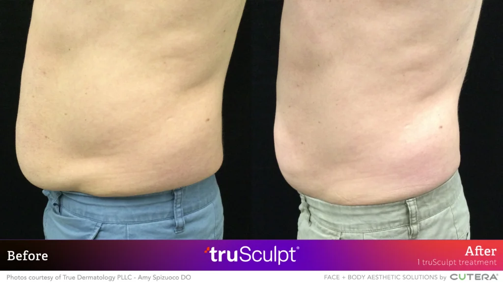 Waistline Fat Reduction with truSculpt: Side Profile Before & After Side view of waistline showing fat reduction and improved contour post-truSculpt treatment.
