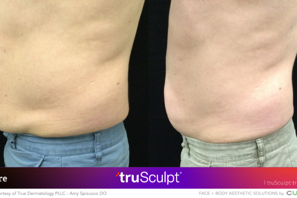Side view of waistline showing fat reduction and improved contour post-truSculpt treatment.