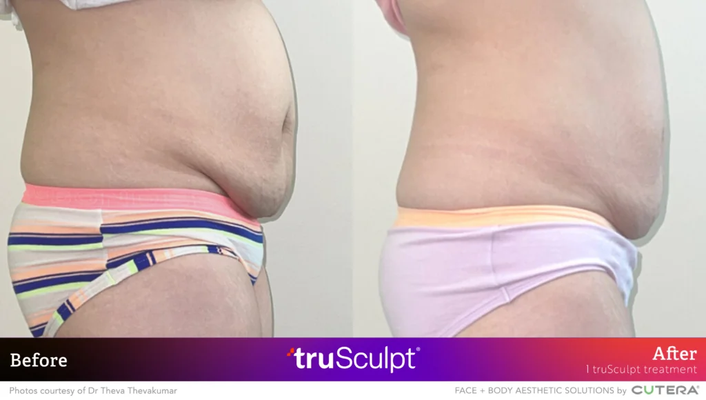 Flank Fat Reduction with truSculpt: Before & After Back View Back profile before and after fat reduction on flanks from truSculpt treatment.