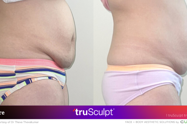 Back profile before and after fat reduction on flanks from truSculpt treatment.