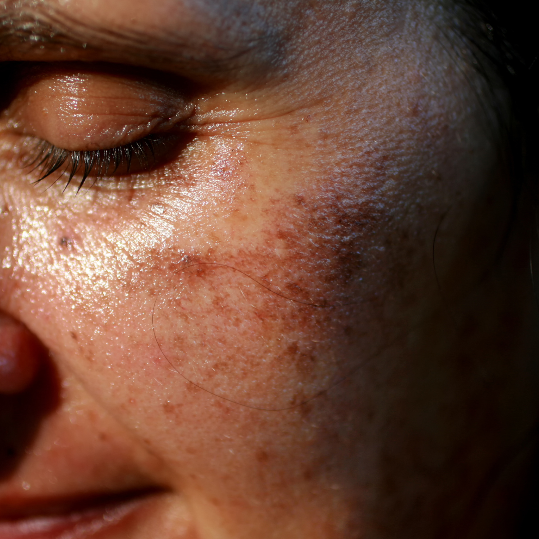 2 pigmentation removal