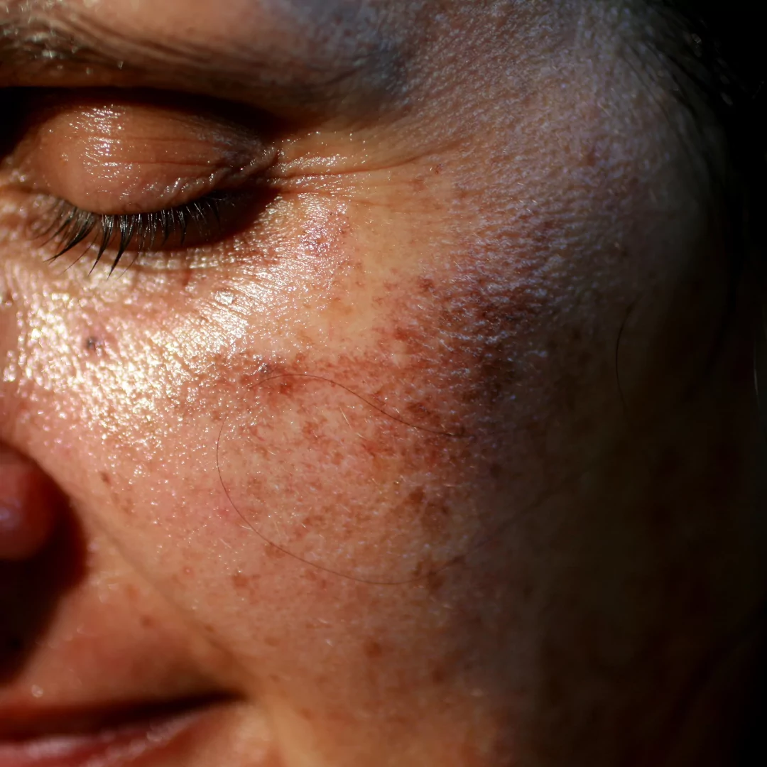 2 pigmentation removal