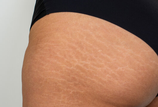 360_F_386271899_RRYVdof2gP04gBNxQgcOWz0ZDO7dopr5 Stretch Marks Removal