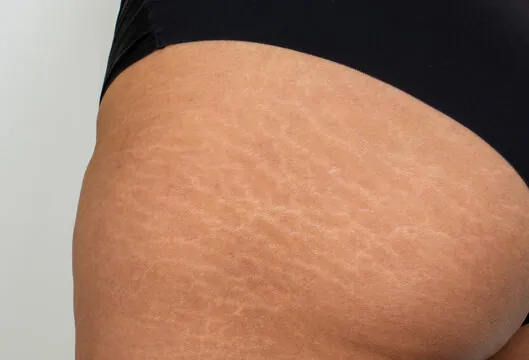 360_F_386271899_RRYVdof2gP04gBNxQgcOWz0ZDO7dopr5 Stretch Marks Removal