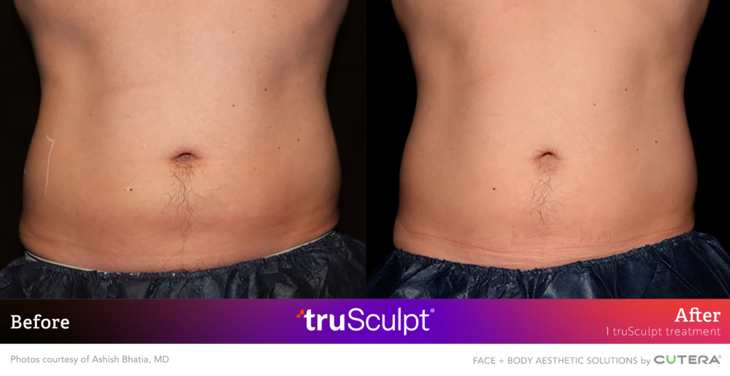 Abdominal Fat Reduction Achieved with truSculpt: Client Results Frontal view before and after images showing fat reduction in the abdominal area with truSculpt.