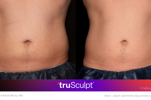 Frontal view before and after images showing fat reduction in the abdominal area with truSculpt.