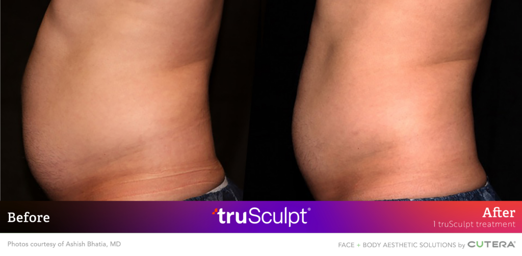 Abdominal Fat Reduction with truSculpt: Frontal Before & After Before and after truSculpt treatment comparison, highlighting fat reduction in the frontal abdominal area.