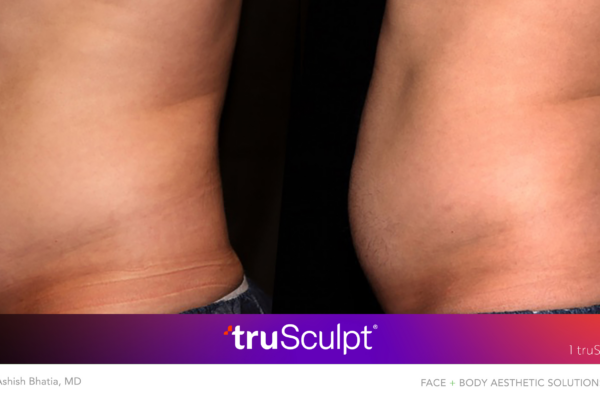 Before and after truSculpt treatment comparison, highlighting fat reduction in the frontal abdominal area.