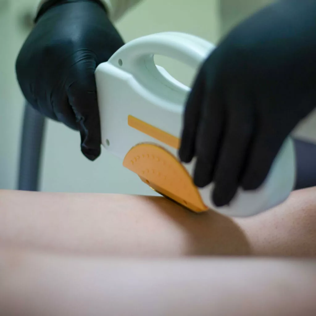 Close Up Legs SuperLUX SHR SHR/IPL Hair Removal