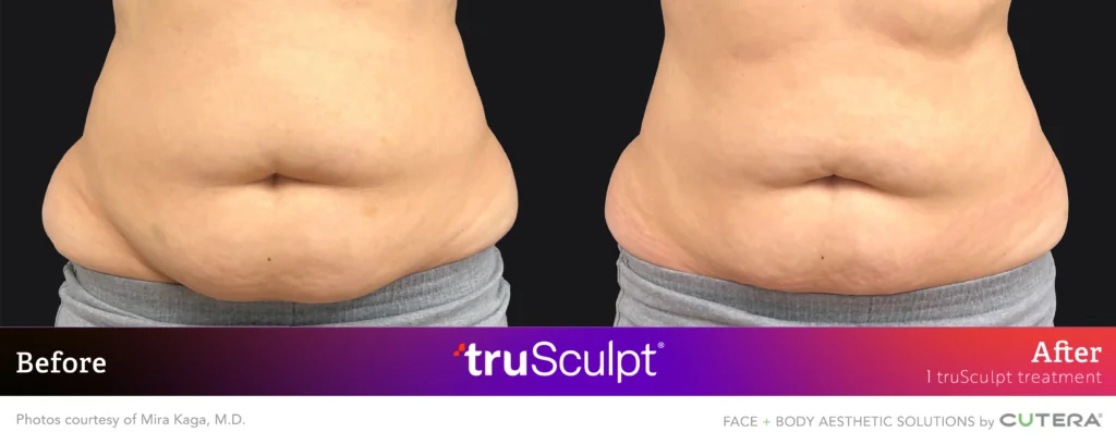Kaga 1Tx B&A 3 Trusculpt Fat Reduction Before