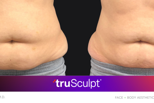 Trusculpt Fat Reduction Before
