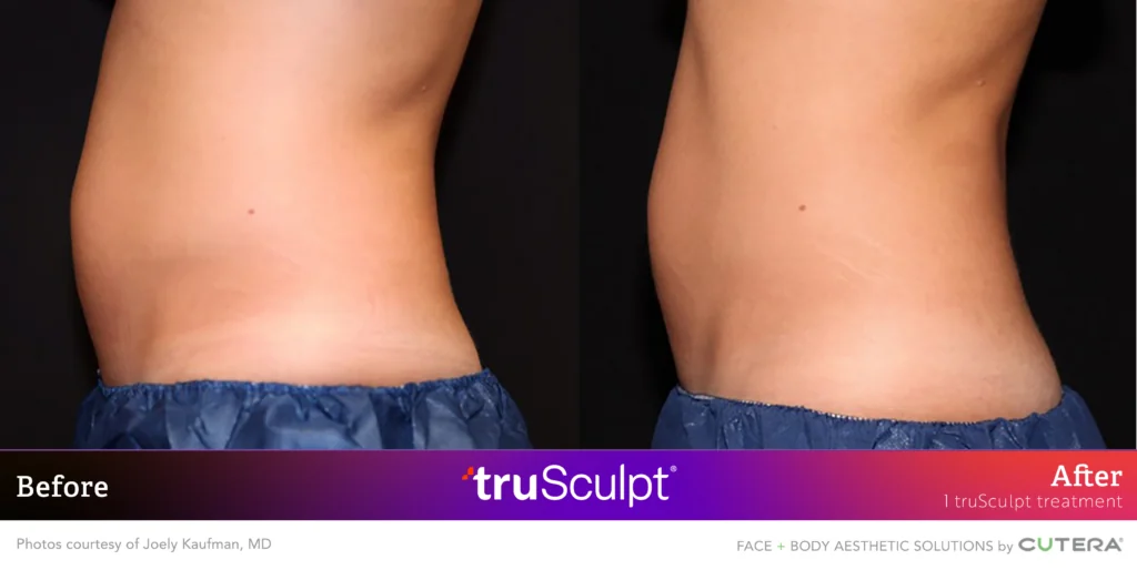 Kaufman 1Tx B&A 1 TruSculpt Body Sculpting Before After Result