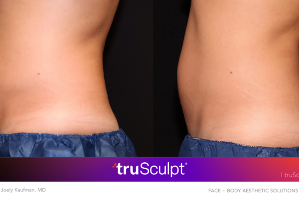 TruSculpt Body Sculpting Before After Result