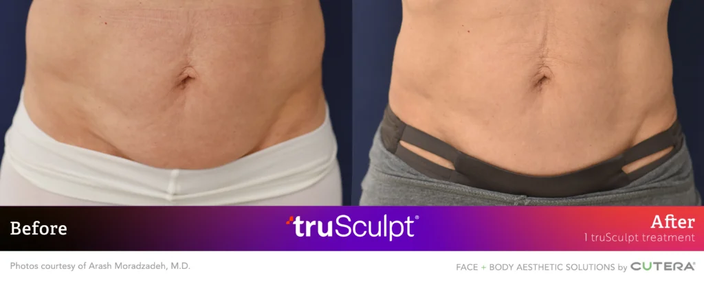 Torso Fat Reduction and Contouring with truSculpt: Patient Results Torso before and after truSculpt treatment, showing fat reduction and improved body contour.
