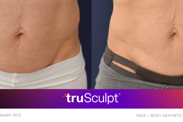 Torso before and after truSculpt treatment, showing fat reduction and improved body contour.