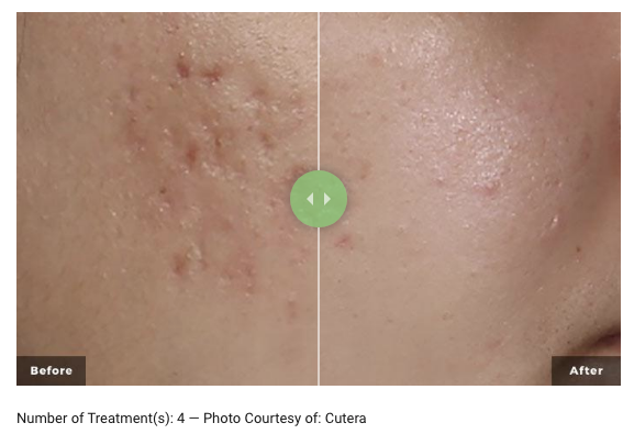 Screen Shot 2023-09-27 at 1.27.31 pm AviClear Treatment before after result