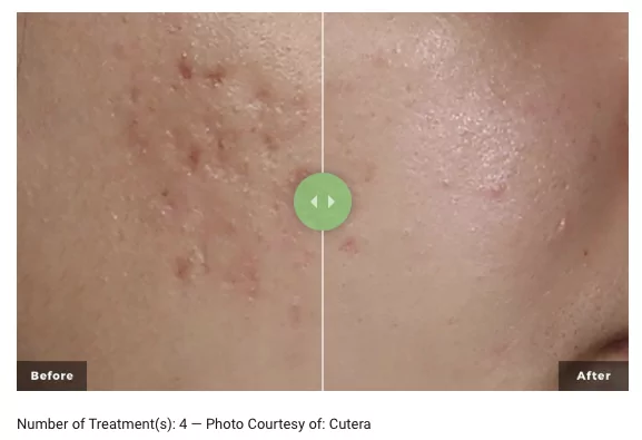 Screen Shot 2023-09-27 at 1.27.31 pm AviClear Treatment before after result