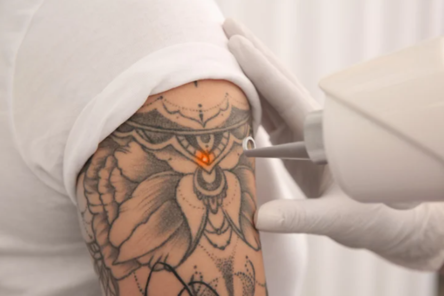 Laser Tattoo Removal