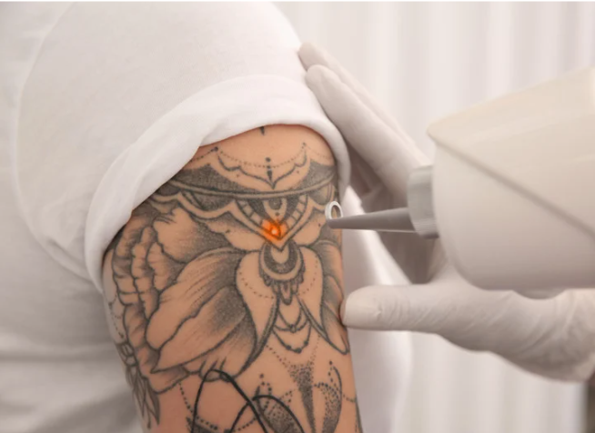 Laser Tattoo Removal