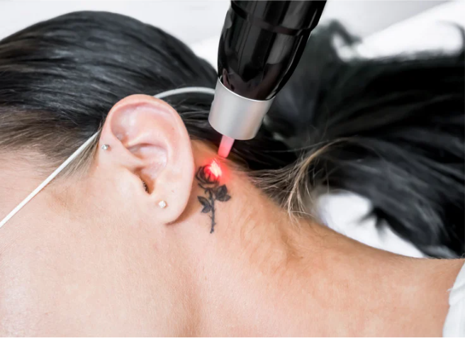 Laser Tattoo Removal 1
