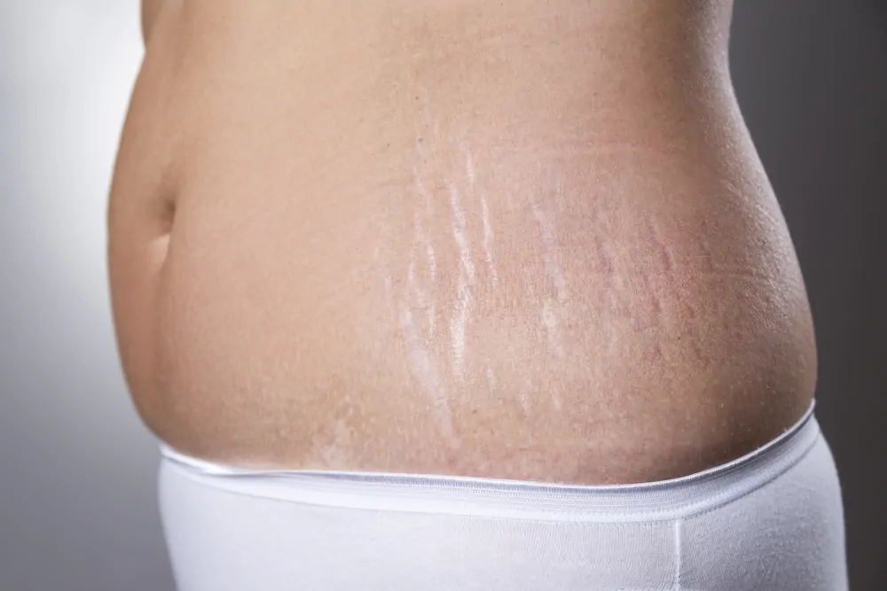 Stretch Marks