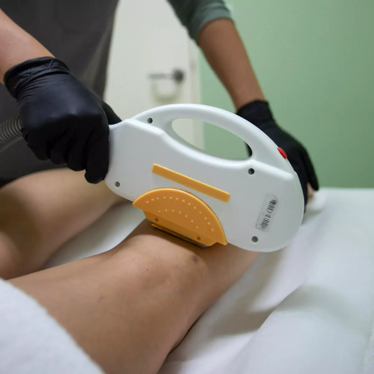 SHR/IPL Hair Removal