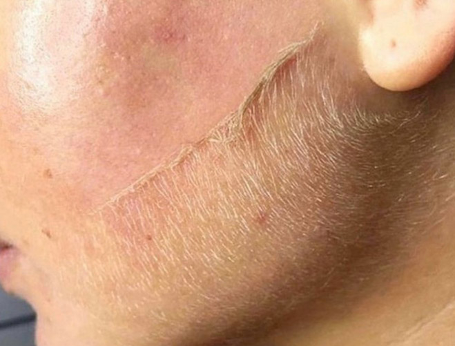 Dermaplaning (Epiblading)