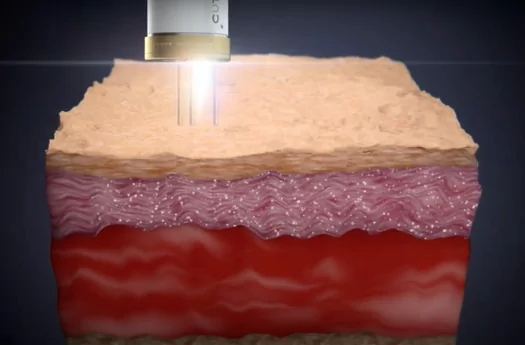 Chemical Peels Hobart