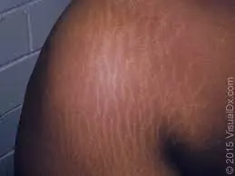 images Stretch Marks Treatment