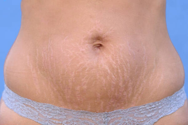 istockphoto-1018909012-612x612 Stretch Marks Removal