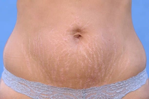 istockphoto-1018909012-612x612 Stretch Marks Removal