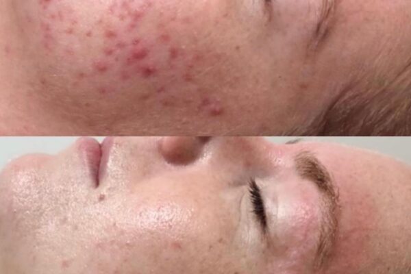 omnlux acne omnlux acne