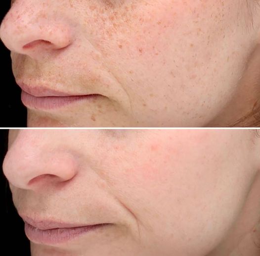 pico genesis before and after Pico Genesis Before After Result