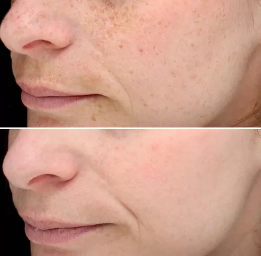 pico genesis before and after Pico Genesis Before After Result