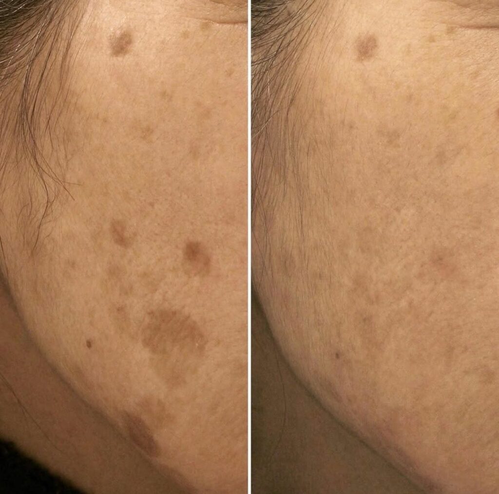 pigmentation Pico Genesis