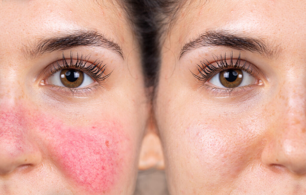 Before and after successful rosacea treatment on the face of a caucasian lady. Redness and visible blood vessels are all removed through laser surgery. Erythema (Skin Redness)