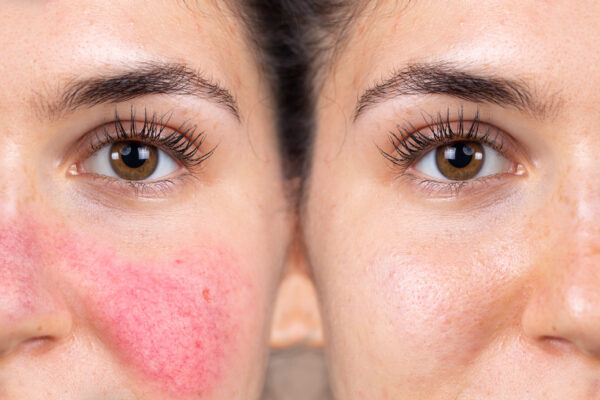 Before and after successful rosacea treatment on the face of a caucasian lady. Redness and visible blood vessels are all removed through laser surgery. Erythema (Skin Redness)