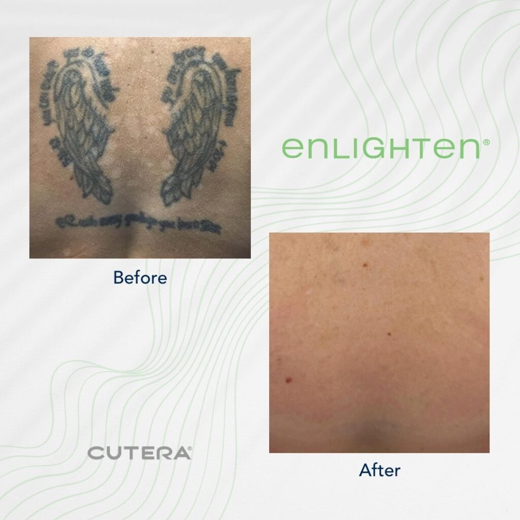 tattoo removal Laser Tattoo Removal