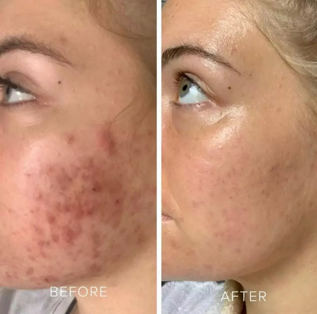 Acne aviclear treatment before and after