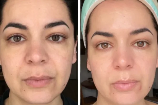 Untitled_design_77 Omnilux LED Light Therapy Before After Result