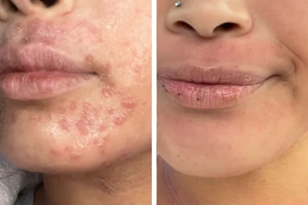 Untitled_design_78 Omnilux LED Light Therapy Before After Result 2