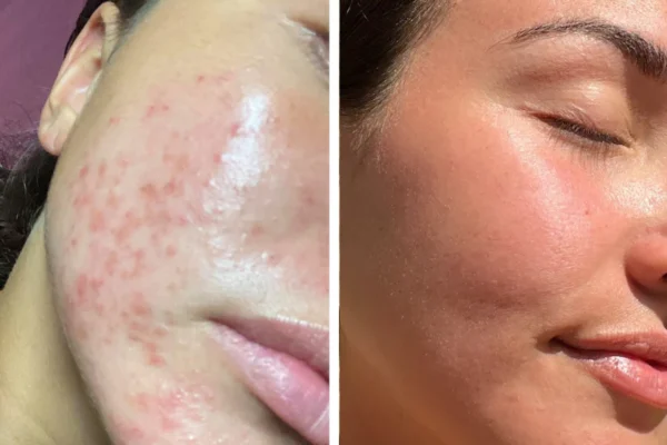 Untitled_design_86 Omnilux LED Light Therapy Before After Result