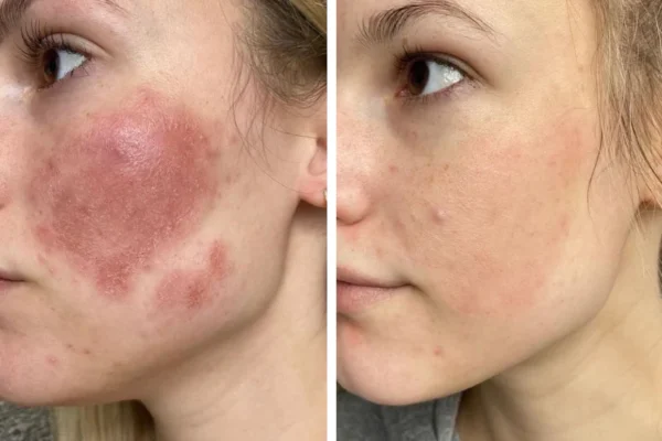 Untitled_design_91 Omnilux LED Light Therapy before after result