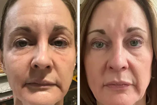 Untitled_design_96 Omnilux LED Light Therapy Before After Result 1