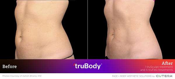 Before and after side view of truSculpt treatment on abdomen by Ashish Bhatia, MD showing visible fat reduction.